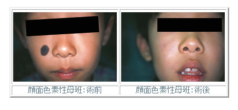 顔面色素性母班(あざ)：術前・術後 症例写真