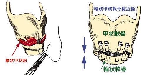 輪状甲状軟骨接近術（一色の甲状軟骨形成4型）手術カット